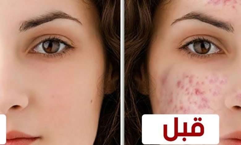 5 طرق لعلاج حبوب الوجه بعد إزالة الشعر 1 383648379543462