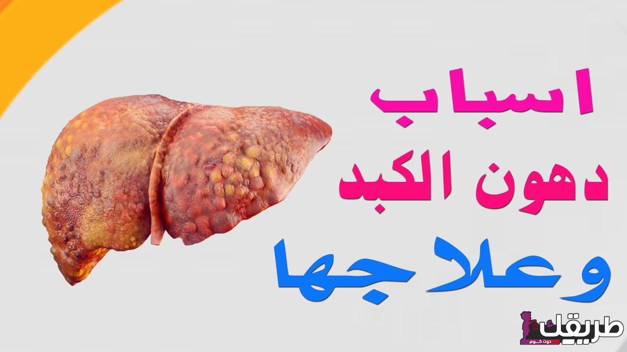 ما هى أعراض دهون الكبد عند النساء وطرق علاجه