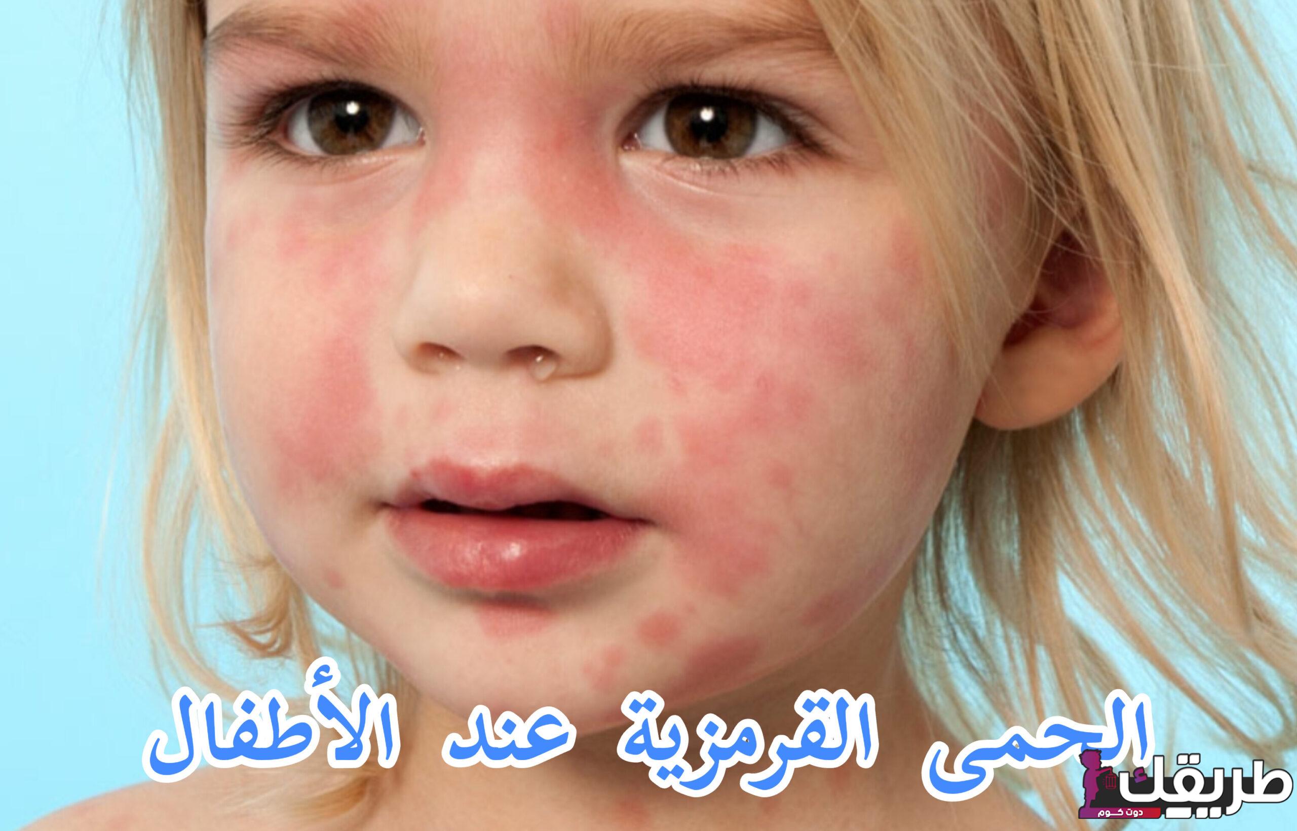 تجربتي مع الحمى القرمزية أسبابه وكيفية الوقاية منه 6 398876877227258