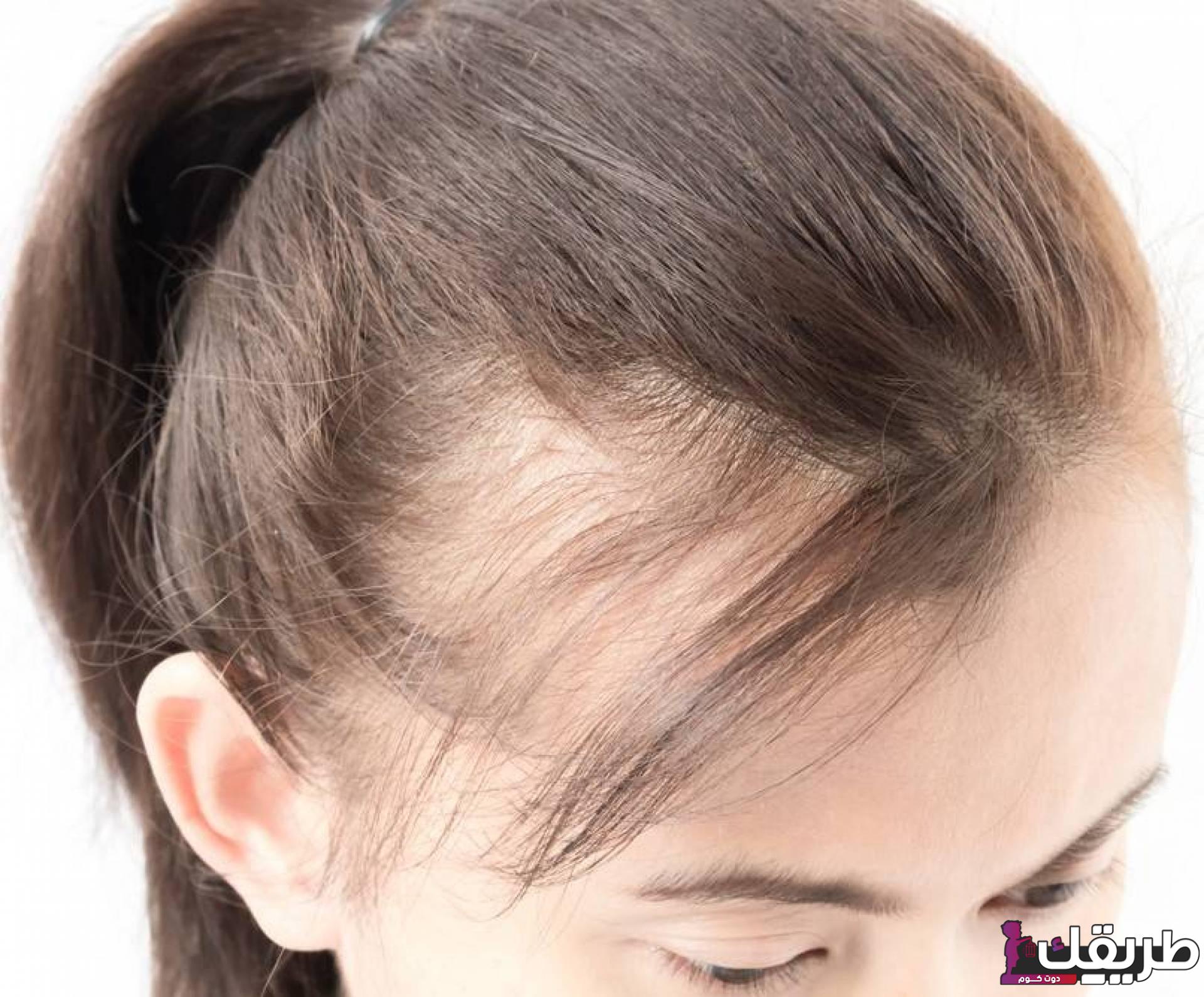 طريقة علاج فراغات الشعر في مقدمة الرأس و5 طرق طبيعية وغير مكلفة 6 533344512427254