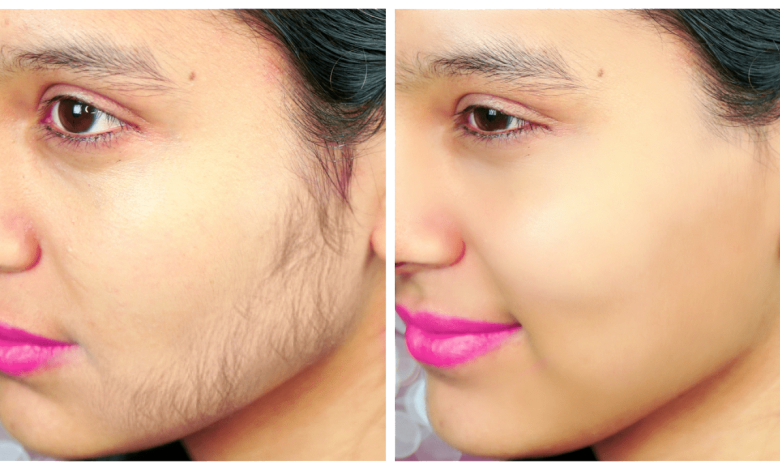 الليزر و التخلص من الشعر الزائد نهائيا 1 578683569057318