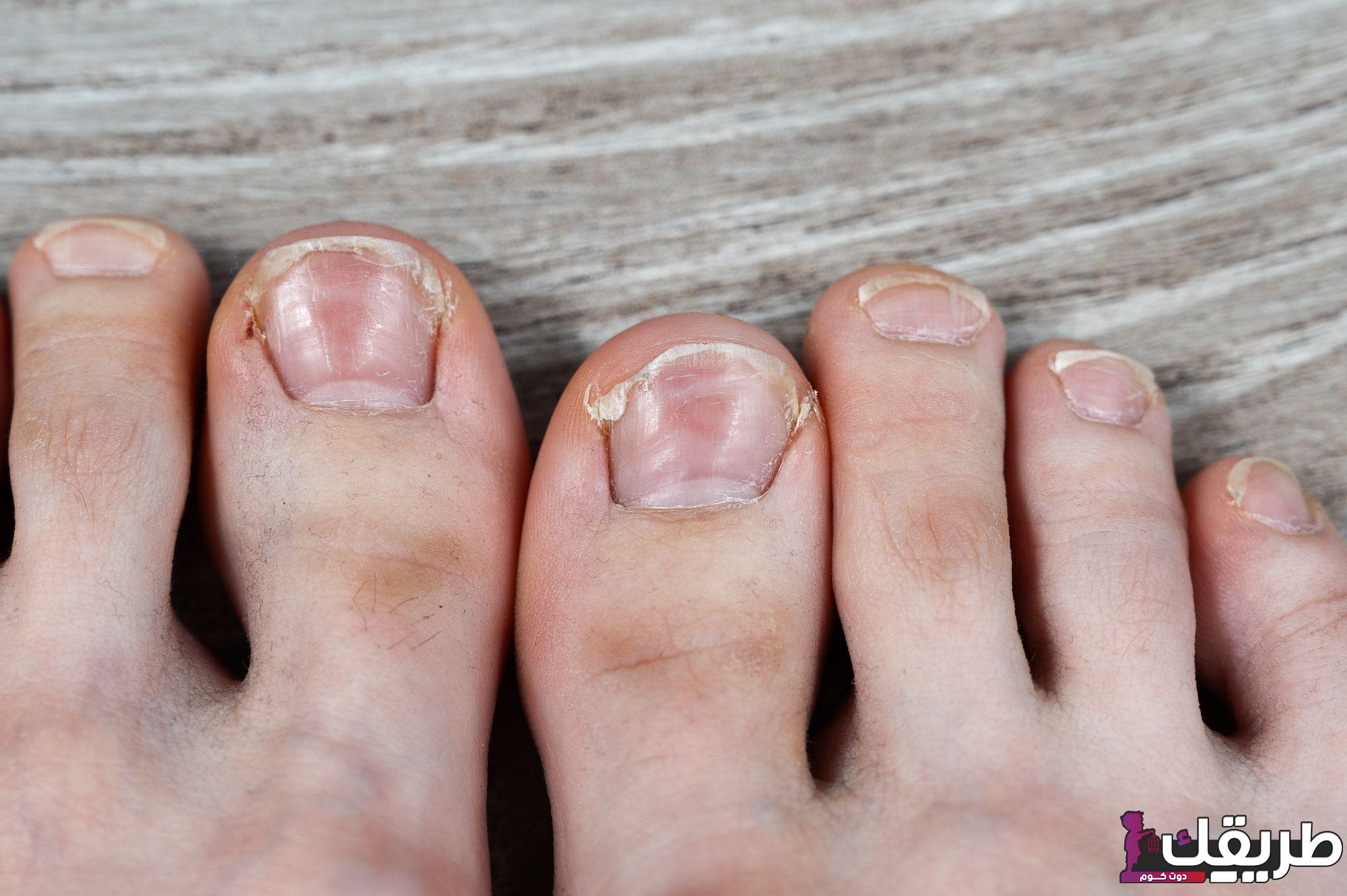 تجربتي مع داحس الظفر وما هي أسباب الإصابة 5 766013723327156