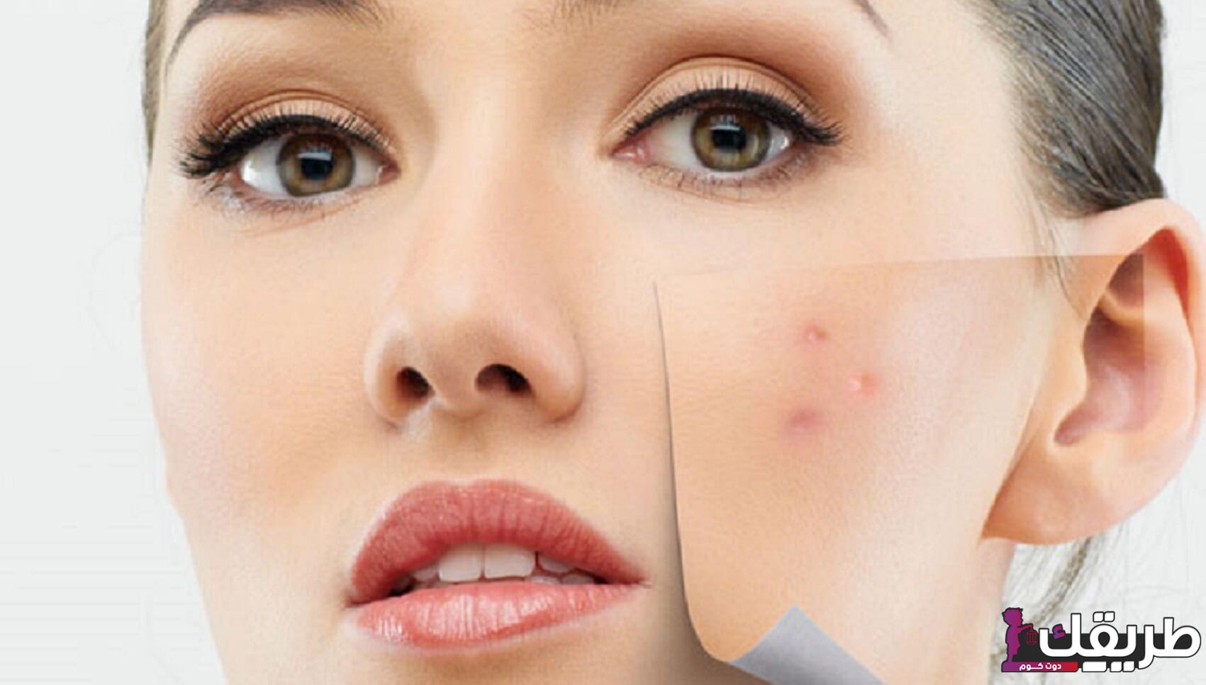 أسرع طريقة لإزالة حب الشباب وتحذير من 8 عادات يوّمية تدمر بشرتك 3 895203877101766