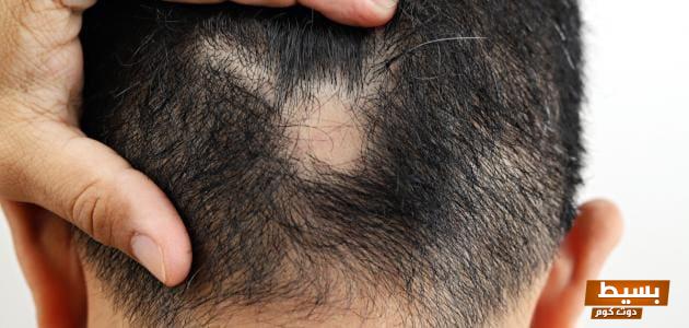 <p><strong>تفسير حلم فراغات في الشعر: معنى عميق يكشف عن مشاعر داخلية وتحديات شخصية</strong></p> 1 تفسير حلم فراغات في الشعر