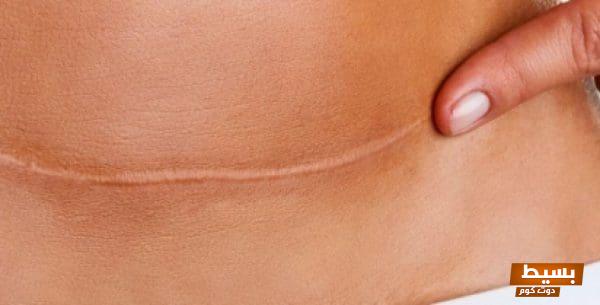 أعراض فتح العملية القيصرية من الداخل تعرف على العلامات التحذيرية المهمة التي يجب الانتباه لها! 1 115 4