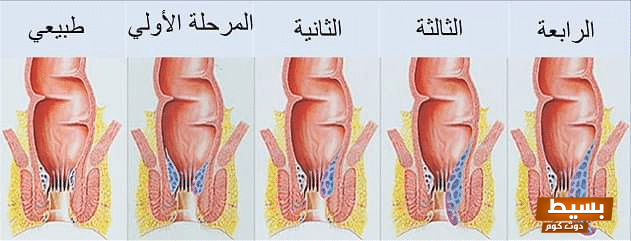 أعراض البواسير عند الرجال اكتشف العلامات المبكرة وكيفية التعامل معها بفاعلية! 1 14 13