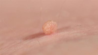 الفرق بين الزوائد اللحمية والبواسير تعرف على الأعراض والعلاج لتجنب المضاعفات الصحية الخطيرة! 2 181211124508729 19