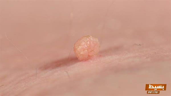 الفرق بين الزوائد اللحمية والبواسير تعرف على الأعراض والعلاج لتجنب المضاعفات الصحية الخطيرة! 1 181211124508729 19