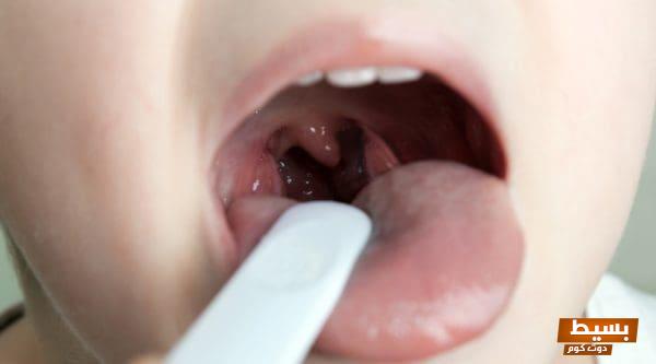 علاج التهاب اللوز عند الأطفال مجرب: الحل الفعال الذي تحتاجه الآن لحماية صحة طفلك! 6 18170f24 38aa 425a b0b7 b4e37dcb69c8