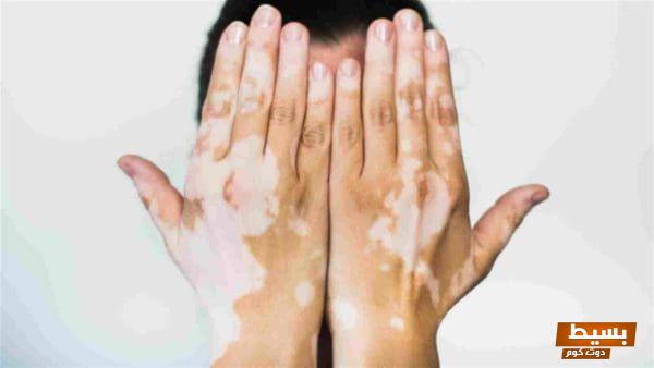 اكتشف الفرق الجوهري بين البهاق والفطريات: معلومات هامة لصحتك الجلدية ورؤى جديدة! 4 191216092505644 هل البهاق سببه نفسي