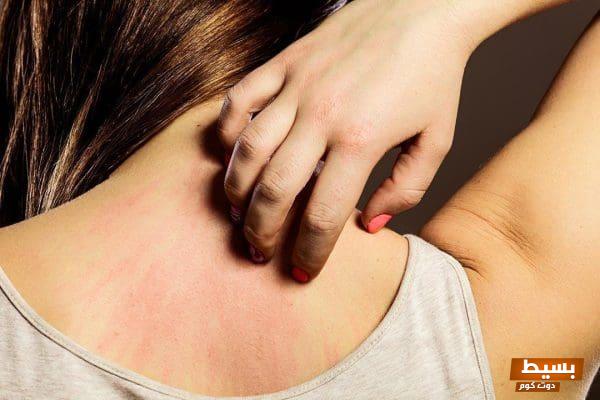 مشروبات فعالة وموثوقة لعلاج الحساسية الجلدية اكتشف الحلول الطبيعية التي ستغير حياتك! 1 2 63