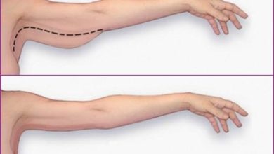 تجربتي الملهمة والمثيرة مع عملية شد الذراعين كيف تحولت إلى أفضل نسخة من نفسي! 7 31 1