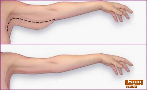 تجربتي الملهمة والمثيرة مع عملية شد الذراعين كيف تحولت إلى أفضل نسخة من نفسي! 1 31 1