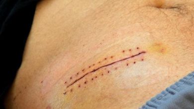 فقدان الشهية المزعج بعد عملية الزائدة أسباب وحلول لتستعيد صحتك وحيويتك! 7 37 3