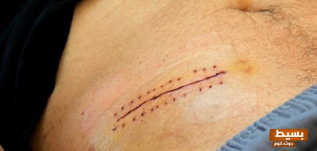 فقدان الشهية المزعج بعد عملية الزائدة أسباب وحلول لتستعيد صحتك وحيويتك! 1 37 3