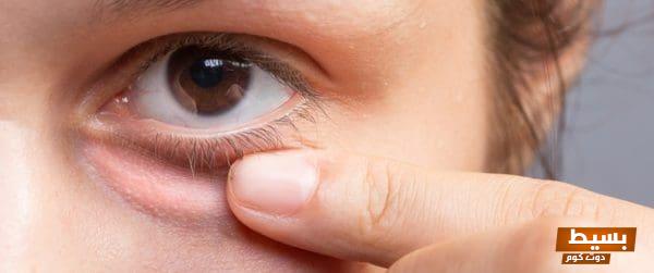 علاج انتفاخ جفن العين السفلي حلول فعّالة لتعزيز جمال عينيك واستعادة تألق نظرتك! 1 413
