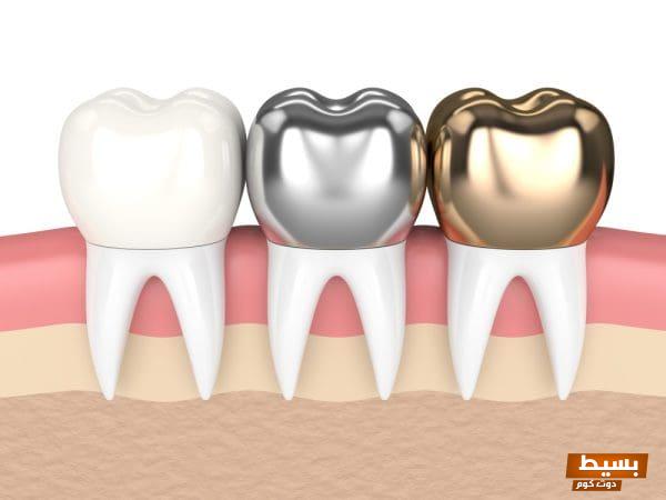 أنواع تلبيسات الأسنان اكتشف أفضل الخيارات لتعزيز ابتسامتك والحفاظ على صحة فمك! 1 71 1