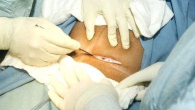 تفسير حلم الولادة القيصرية بدون ألم للمتزوجة: دلالات وأسرار قد تغير حياتك! 7 91 7