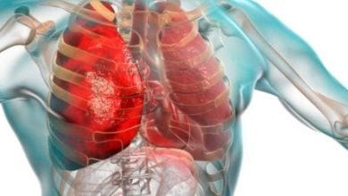 هل التهاب الرئة خطير اكتشف حقائق مثيرة قد تنقذ حياتك! 6 956