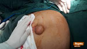 مدة الشفاء بعد عملية الخراج رحلة التعافي الشاملة وأهم النصائح لضمان صحة مثالية! 7 download 2