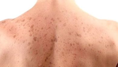 اكتشف الأسباب العجيبة وراء ظهور بقع بنية على الظهر والصدر وكيفية التغلب عليها بفعالية! 3 أسباب ظهور بقع بنية على الظهر والصدر