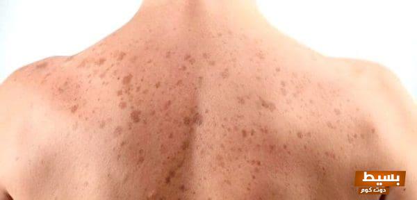 اكتشف الأسباب العجيبة وراء ظهور بقع بنية على الظهر والصدر وكيفية التغلب عليها بفعالية! 1 أسباب ظهور بقع بنية على الظهر والصدر