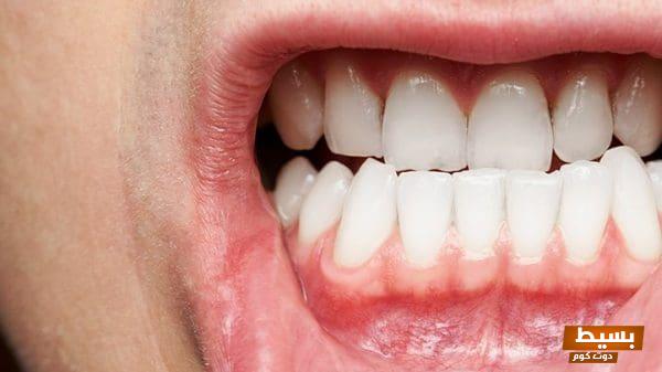 أمراض الفم واللثة بالصور: اكتشف المخاطر الصحية وكيفية الوقاية منها! 5 أمراض الفم واللثة بالصور