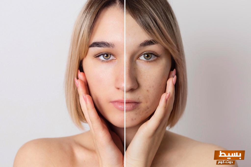 التقشير الكيميائي والتقشير البارد اكتشف أسرار البشرة النضرة والجذابة! 3 التقشير الكيميائي والتقشير البارد