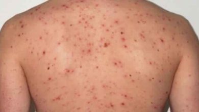 رؤية شخص مصاب بمرض جلدي في المنام: دلالاتها الغامضة وتأويلاتها العميقة في عالم الأحلام! 5 الطفح الجلدي مرض الايدز