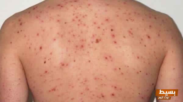 رؤية شخص مصاب بمرض جلدي في المنام: دلالاتها الغامضة وتأويلاتها العميقة في عالم الأحلام! 1 الطفح الجلدي مرض الايدز