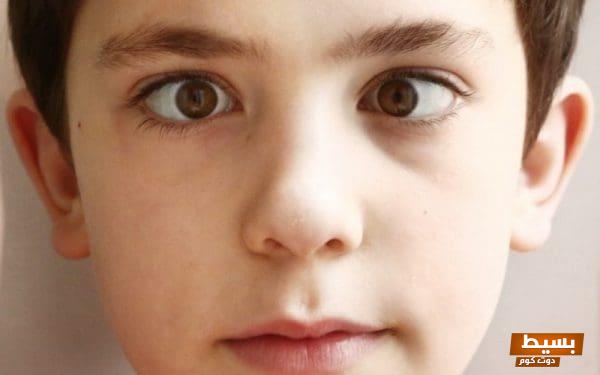 اكتشف الفرق المذهل بين الحول والحور في العين: تفاصيل مذهلة ستغير فهمك لرؤية العالم! 3 الفرق بين الحول والحور6