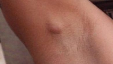 انتفاخ ملحوظ تحت الإبط الأيمن بدون ألم اكتشف الأسباب وحافظ على صحتك! 5 انتفاخ تحت الابط الايمن بدون الم 2