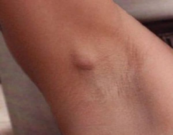 انتفاخ ملحوظ تحت الإبط الأيمن بدون ألم اكتشف الأسباب وحافظ على صحتك! 1 انتفاخ تحت الابط الايمن بدون الم 2