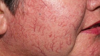 تجربتي المذهلة مع الشعيرات الدموية اكتشافات غير متوقعة وتأثيرات مدهشة! 5 تجربتي مع الشعيرات الدموية