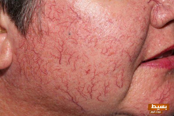 تجربتي المذهلة مع الشعيرات الدموية اكتشافات غير متوقعة وتأثيرات مدهشة! 1 تجربتي مع الشعيرات الدموية