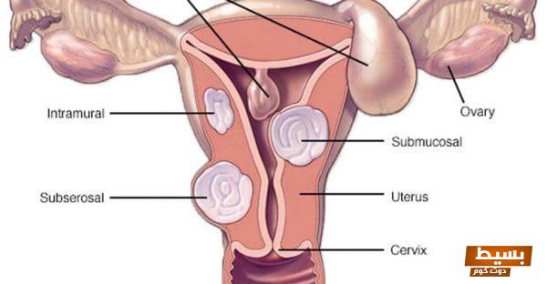 تجربتي الملهمة مع تليف الرحم رحلة الشفاء والتحديات التي واجهتها 1 تجربتي مع تليف الرحم