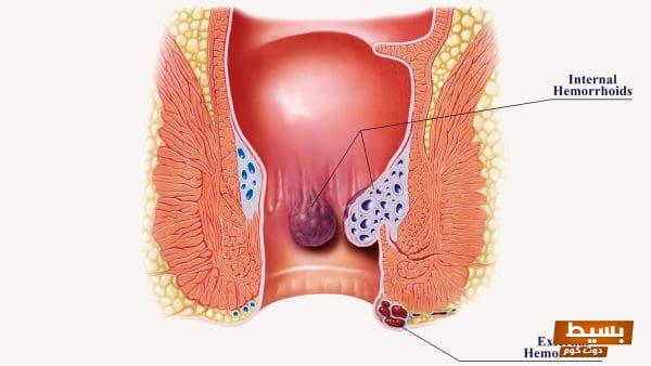 علاج فعال وآمن للبواسير الداخلية في المنزل: خطوات بسيطة وأساليب طبيعية لتخفيف الألم والشفاء السريع