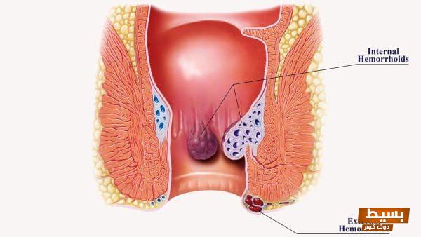 علاج فعال وآمن للبواسير الداخلية في المنزل: خطوات بسيطة وأساليب طبيعية لتخفيف الألم والشفاء السريع 5 علاج البواسير الداخلية في المنزل