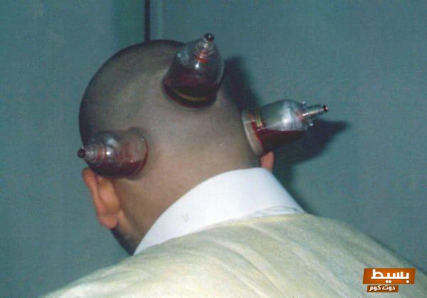 الحجامة في الرأس شفاء من سبع: اكتشف سر الطب البديل الذي يعيد لك صحتك وحيويتك! 6 علاج الصداع بالحجامة