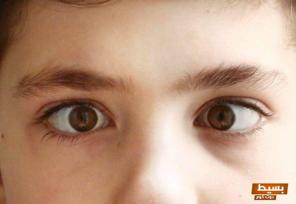 أسباب وعلاج انحراف العين البسيط عند الأطفال: دليل شامل لفهم الحالة وتحسين الرؤية! 7 علاج انحراف العين البسيط عند الأطفال