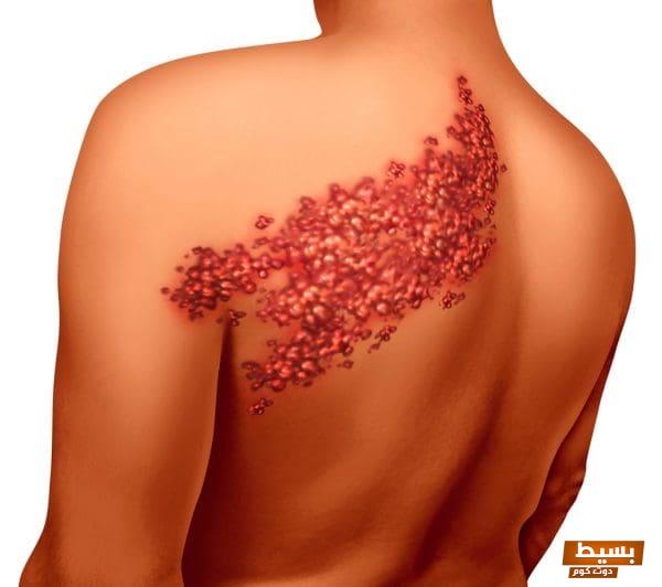 كيف تنتقل عدوى الحزام الناري: اكتشف الحقائق المثيرة والمفاجئة التي يجب أن تعرفها لحماية نفسك! 4 كيف تنتقل عدوى الحزام الناري