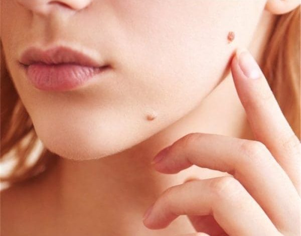 ما هو الثالول بالصور اكتشف الأسباب والعلاجات الفعالة لصحة جلدك! 1 ما هو الثالول بالصور2