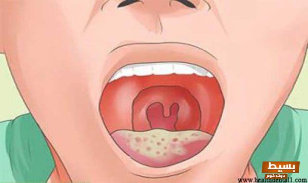 متى تظهر أعراض الإيدز في الفم وكيفية العلاج الفعّالة: دليل شامل لكل ما تحتاج معرفته للحفاظ على صحتك! 7 متى تظهر اعراض الايدز في الفم 1200x712 1