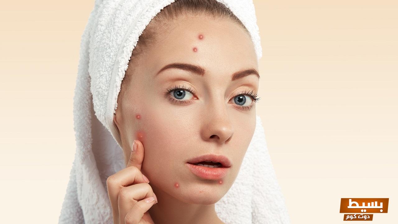 وصفات لعلاج حبوب الوجه طرق فعالة ومجربة للحصول على بشرة نقية خالية من الشوائب 15 وصفات لعلاج حبوب الوجه